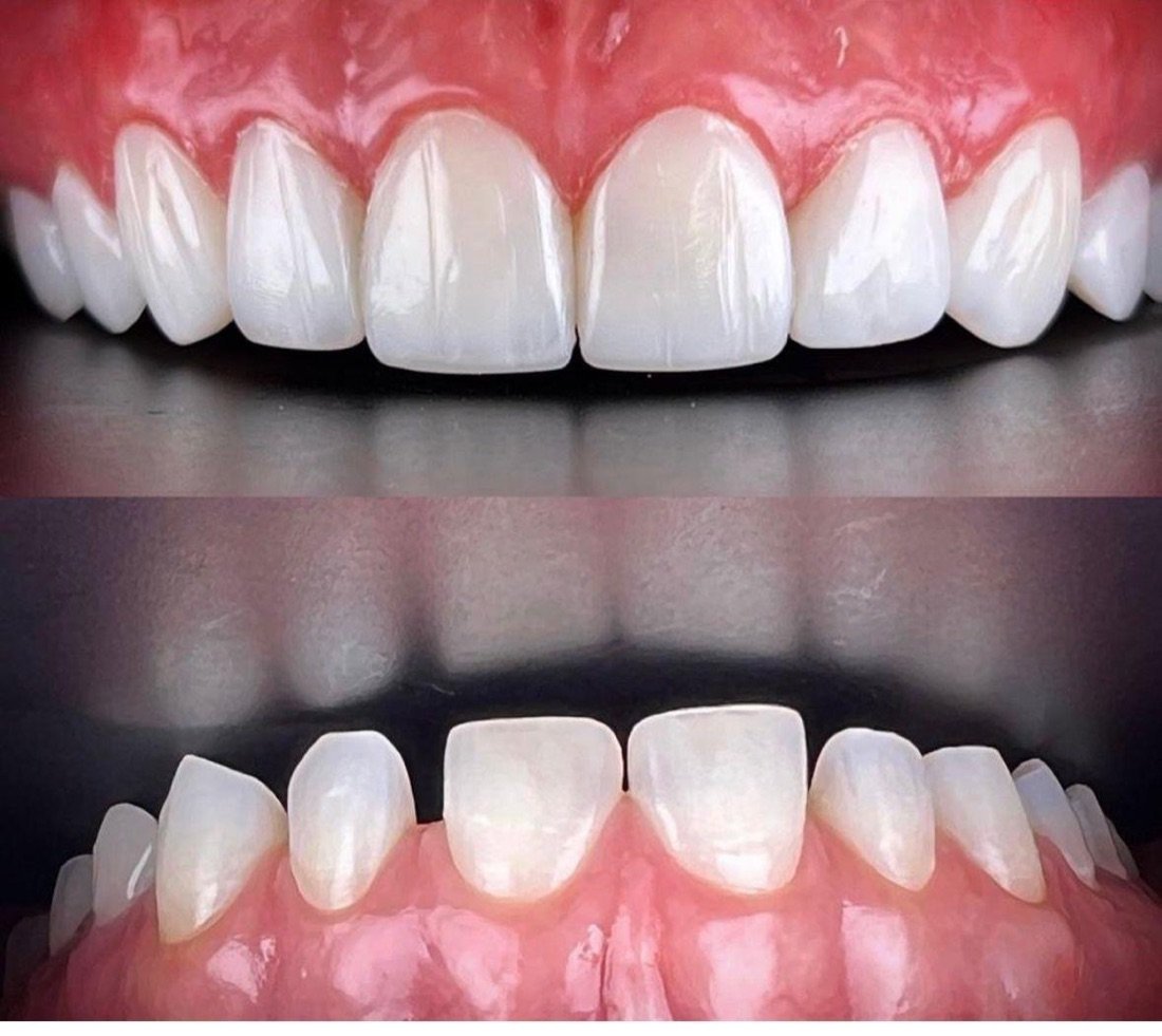 Detalhes de prótese dentária