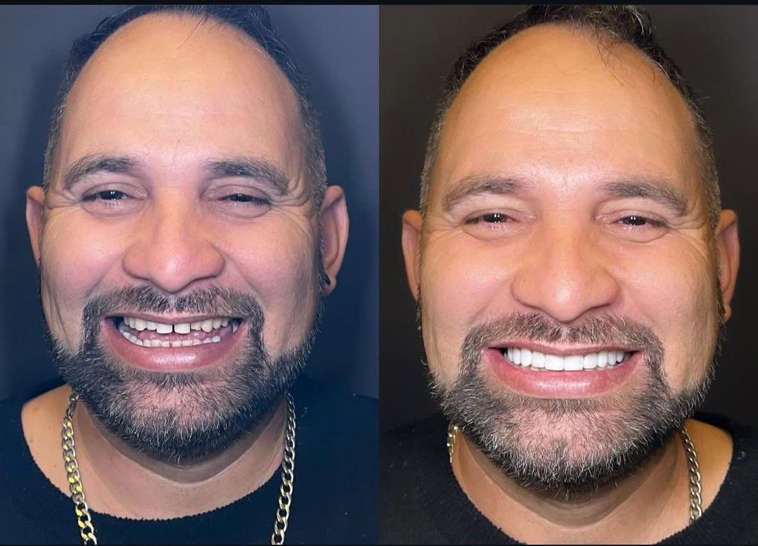 Comparativo do sorriso de um paciente